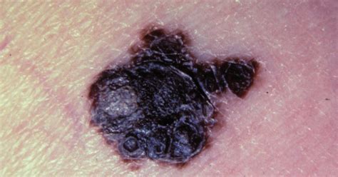 melanoma 4 stadio sintomi